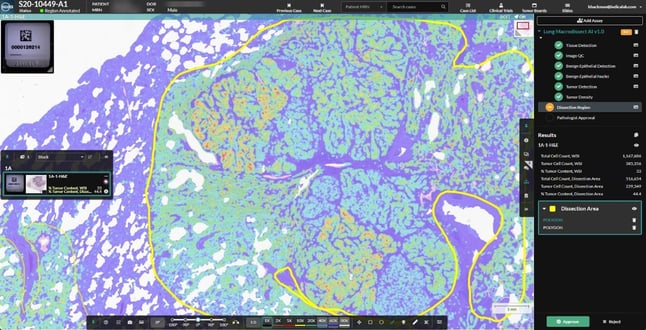 Lung Macrodissect AI is seamlessly deployed in HALO AP®, quantifies tumor content, streamlines tumor annotation, and ensures specimen quality for downstream analysis