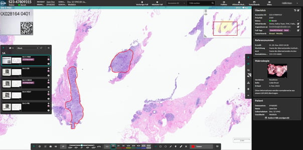 The HALO AP® user interface localized in German shows a breast case with gross specimen